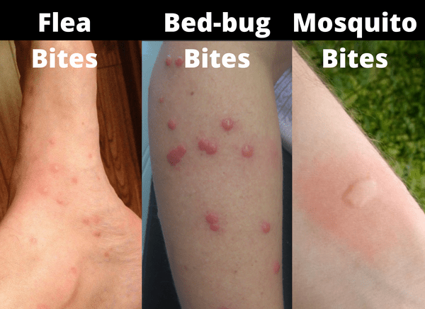 Where do bed bugs normally bite?
