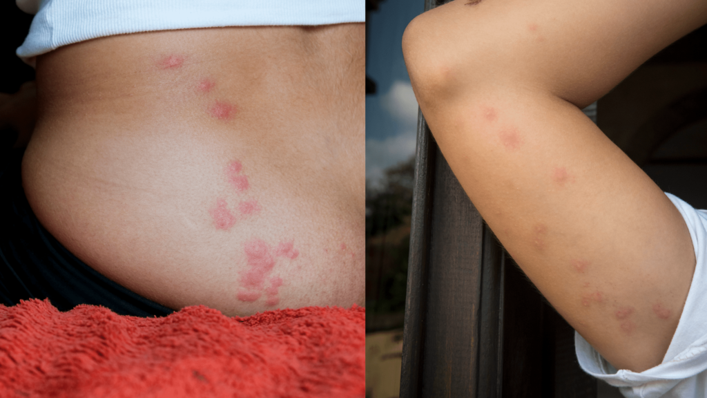The Most Common Places Where Bed Bugs Bite